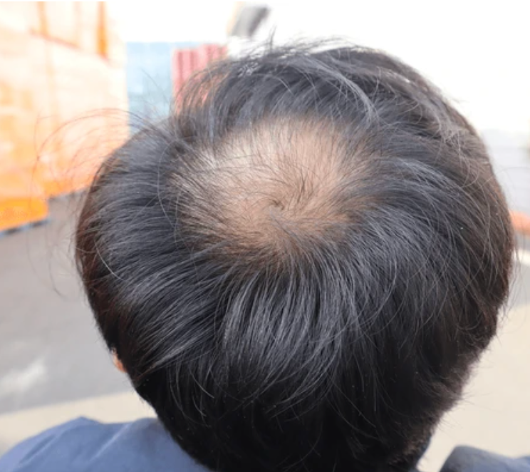 💥 El Secreto Capilar que Detiene la Caída y Revive tu Cabello.